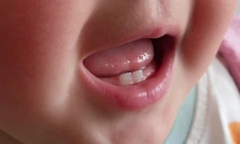 Các bệnh răng miệng phổ biến ở trẻ