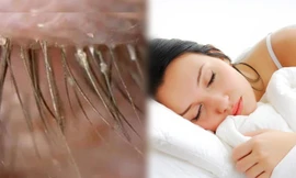 Kinh hoàng 100 con bọ trên lông mi vì… 5 năm không giặt vỏ gối