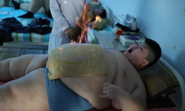 Cậu bé 11 tuổi nặng 145kg đốt mỡ thừa bằng giác hơi