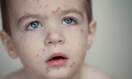 Thủy đậu, quai bị vào mùa: Chớ coi thường