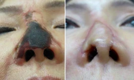 Bị hoại tử mũi sau khi tiêm chất làm đầy