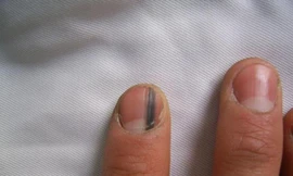 Phát hiện dấu hiệu ung thư tiềm ẩn qua móng tay, tóc, răng...