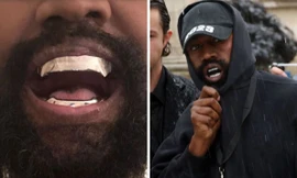 Kanye West gây sốc khi nhổ hết răng thật