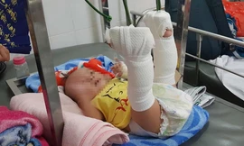 Bé trai 4 tháng tuổi nghi bị cha đánh xuất huyết não