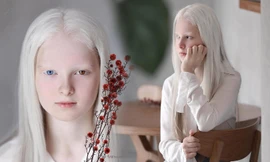 Sửng sốt với vẻ đẹp siêu thực của cô bé bạch tạng có 2 màu mắt cực hiếm