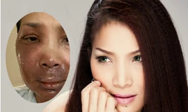 Hồng Ngọc lần đầu công khai hình ảnh khuôn mặt bị bỏng đến 2/3 và chia sẻ điều xúc động