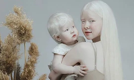 Diện mạo khác lạ của hai chị em người Kazakhstan bị bạch tạng gây 'sốt'