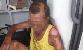 Ông P. bị bỏng toàn thân đang được cấp cứu tại bệnh viện 