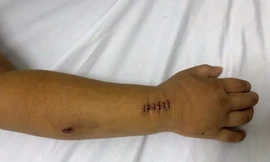 Hà Nội: Đang chơi với bạn, bé 5 tuổi vô tình trúng đạn súng hơi 