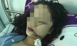 Nạn nhân Q. đang điều trị tại bệnh viên với nhiều vết thương ở vùng mặt 