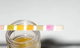 Thử nước tiểu phát hiện loãng xương và ung thư xương