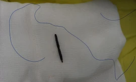 Sơ ý khi cắt cỏ, người đàn ông bị đoạn dây kẽm gai xuyên từ bụng lên tim