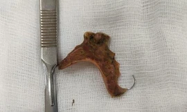 Nuốt nhầm hàm răng giả lúc uống thuốc, cụ bà U70 bị thủng đại tràng