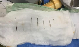 Stress, người phụ nữ tự đâm 7 chiếc kim khâu vào lồng ngực