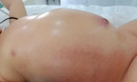 Bé trai 5 ngày tuổi bị thủng dạ dày bẩm sinh