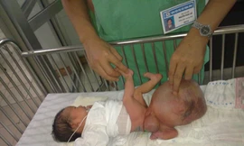 Đại phẫu cắt u quái hơn 2 kg cho trẻ một tuần tuổi