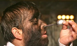 ‘Người sói’ nhét thìa vào mũi