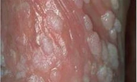 Nam giới nhiễm virus HPV cũng tương đối phổ biến