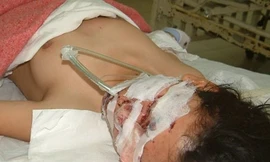 Nổ bình khí bơm bóng, 5 người trọng thương