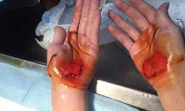 Đôi bàn tay sưng phồng, chảy máu của một học sinh bị phạt. Ảnh: SCMP