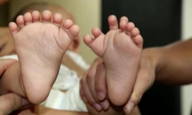 Bé trai có tổng cộng 16 ngón trên bàn tay và 15 ngón chân nhưng lại không có ngón tay cái hay ngón chân cái nào.