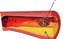 Cứu tinh cho bệnh nhân đau tim (Đau thắt ngực)