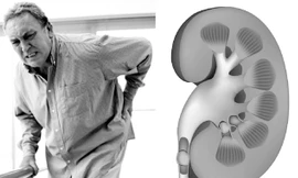 Bệnh thận ảnh hưởng đến chất lượng cuộc sống