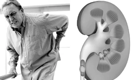 Bệnh thận ảnh hưởng đến chất lượng cuộc sống