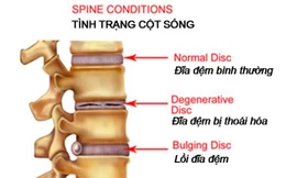 Thoái hóa đĩa đệm với sự hình thành gai xương