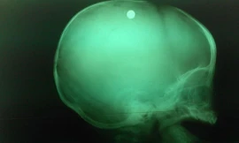 Viên đạn trong đầu bé trai 6 tuổi qua chụp X-quang- ảnh BV nhi đồng 2. 