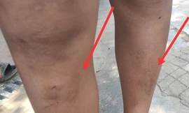 Ném đá văng vào nhà hàng xóm, 5 cháu nhỏ bị đánh bầm tím