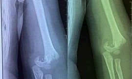 Hình ảnh chụp phim cho thấy trẻ bị gãy xương cánh tay. 