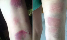 Chân học sinh được cho là giáo viên đánh