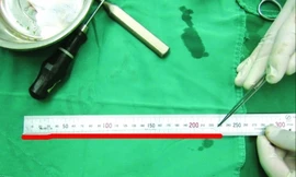 Phát hiện sâu ký sinh trong não người