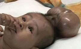 Sửng sốt bé trai có tới...2 đầu