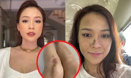 Loạt ảnh Sam "tả tơi" trên phim trường khiến fan xót xa: Chân bầm tím, mặt sưng phù