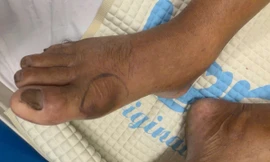 Ra thăm vườn, cụ ông 70 tuổi ở Bạc Liêu bị rắn hổ đất cắn nguy kịch