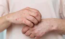 Xác nhận ca mắc đậu mùa khỉ ở Cà Mau, gấp rút cách ly người tiếp xúc gần