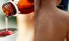 Bị cho uống nhầm thuốc mọc tóc thay vì thuốc dạ dày, 20 trẻ em “như biến thành người sói“