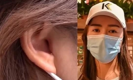 Vào viện thẩm mỹ để sửa mũi, cô gái sốc khi phát hiện ra đã bị cắt mất một phần tai