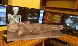 Sự thật về xác ướp 'mang thai' mắc ung thư