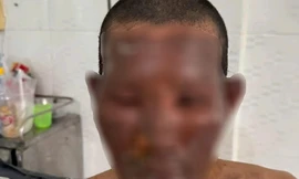 Nổ bình gas mini, 8 người đang ăn giỗ phải nhập viện