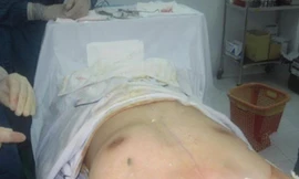 Hình ảnh một ca phẫu thuật nâng ngực ở nam giới.