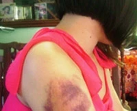 Nữ sinh bị cha bạo hành phải nhập viện