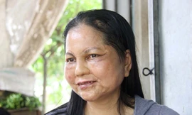 'Nữ sinh hóa bà lão' ở Hội An: Sức khỏe giảm sút