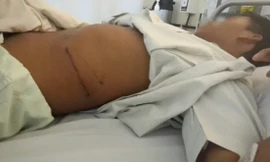 Vết sẹo mổ lấy thận của Maung Maung. Ảnh: CNN.