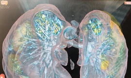 Hình ảnh 3D phổi bệnh nhân COVID-19. Ảnh: Bệnh viện ĐH George Washington.