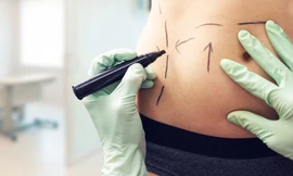 Hút mỡ chiếm 14,8% tổng số ca phẫu thuật thẩm mỹ trên toàn thế giới năm 2021. Ảnh: Ảnh: Adobe Stock.