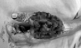 Bàn tay trái của em Q. bị dập nát, gãy ngón và lộ gân xương