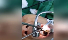 Bản tin 8H: Bác sĩ gắp đỉa sống trong họng bệnh nhân Hà Giang